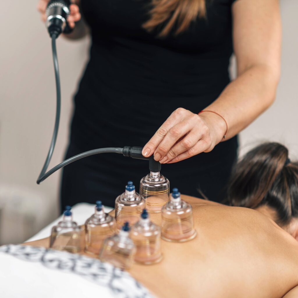 cupping therapy 3 - Hope Wellness
