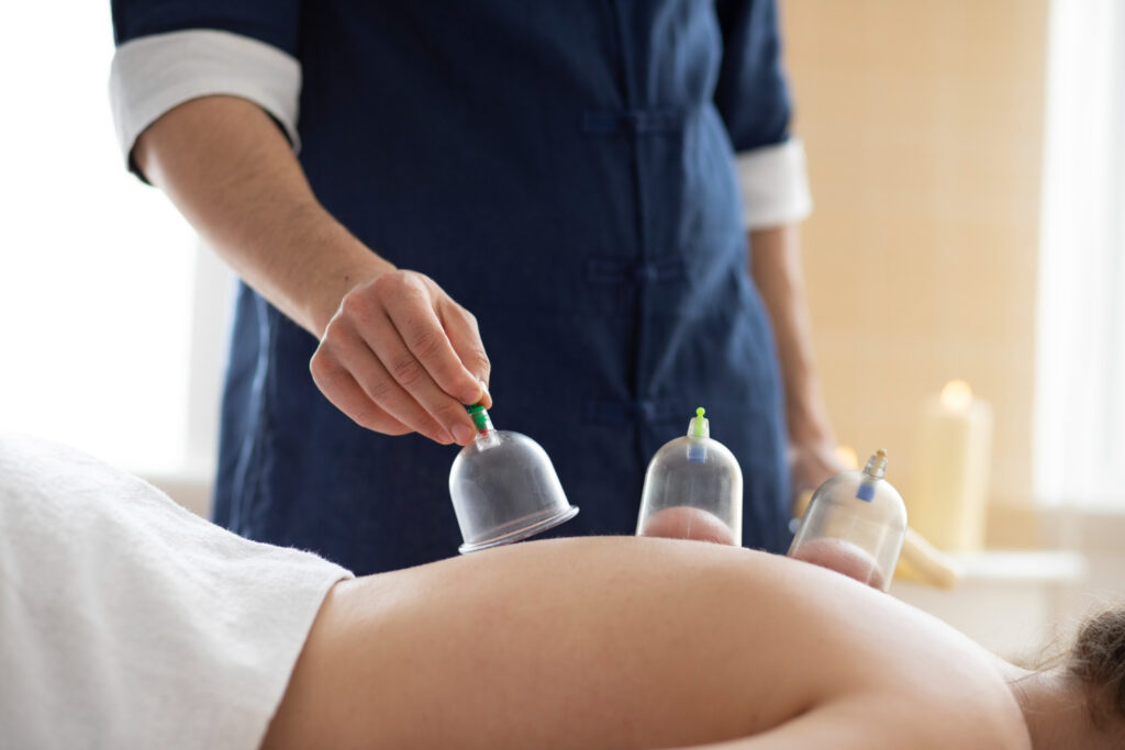 Cupping Therapy Milton session for back pain relief at wellness clinic.